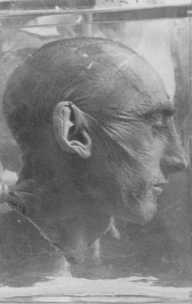 Uma vítima das experiências médicas nazistas. Foto tirada no campo de concentração de Buchenwald, Alemanha, data indeterminada.